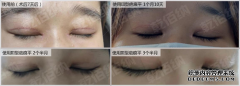 双眼皮术后用了乾佰纳疤痕平，效